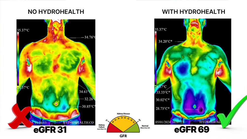 1734990027379__strong_before_after_of_body_x_ray___heat_scan_showing_improvement_and_below_it_lab_test_results_showing_eGFR_in_the_left_34_and_the_right_69__smaller_1__compressed